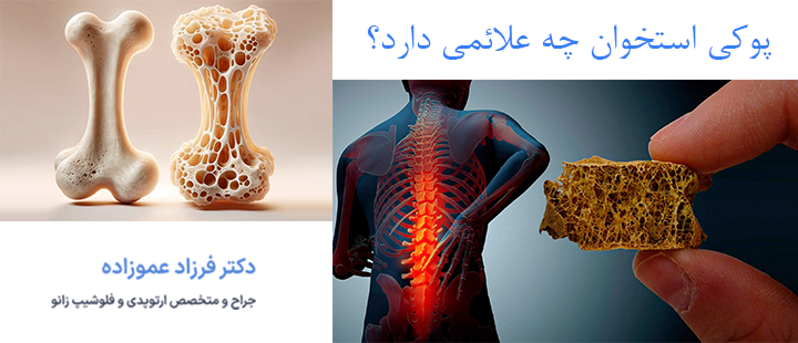 آشنایی با پوکی استخوان