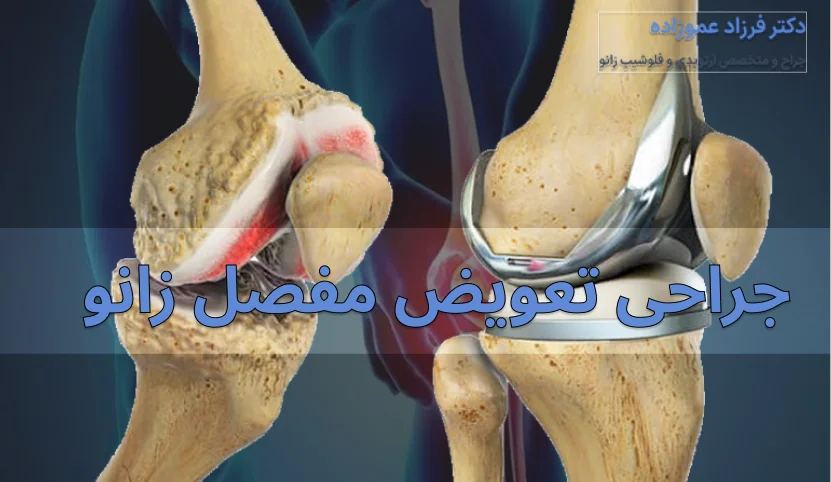 جراحی تعویض مفصل زانو