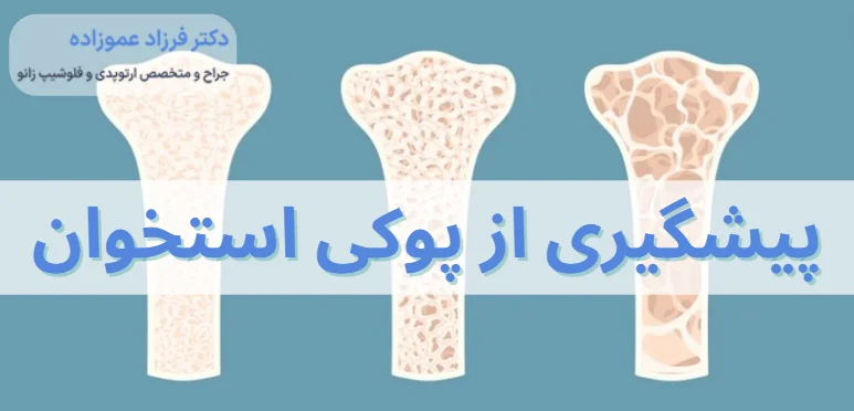 پیشگیری از پوکی استخوان