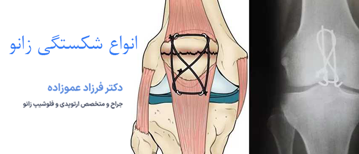 انواع شکستگی زانو