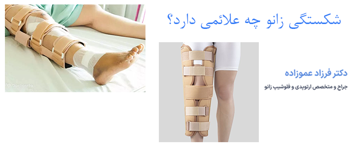 شکستگی زانو چه علائمی دارد؟