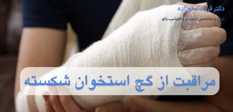 مراقبت از گچ