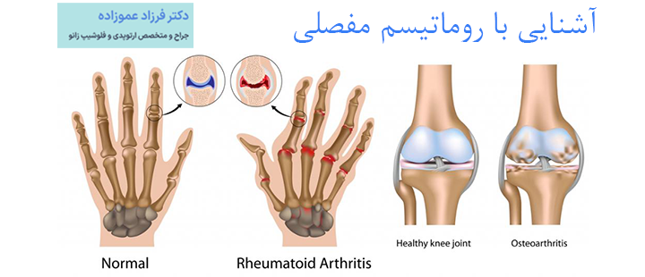 روماتیسم مفصلی