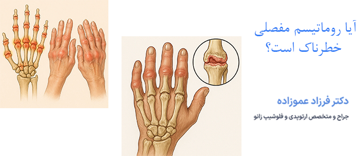 آیا روماتیسم مفصلی خطرناک است؟