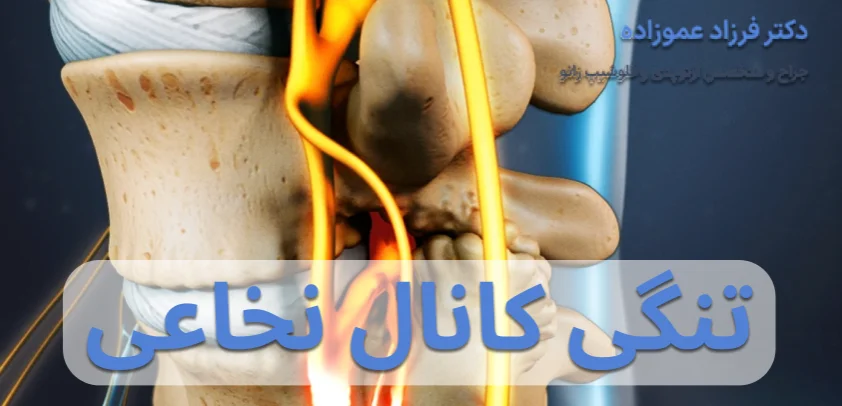 تنگی کانال نخاعی