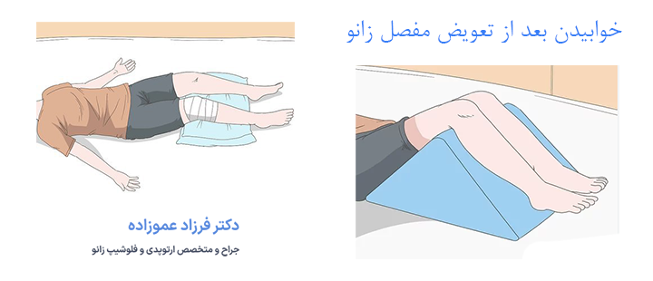 درباره خوابیدن بعد از تعویض مفصل زانو