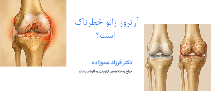 آرتروز زانو خطرناک است؟