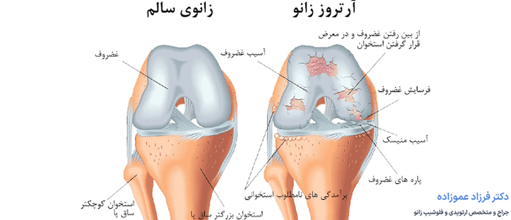 آرتروز زانو چیست؟