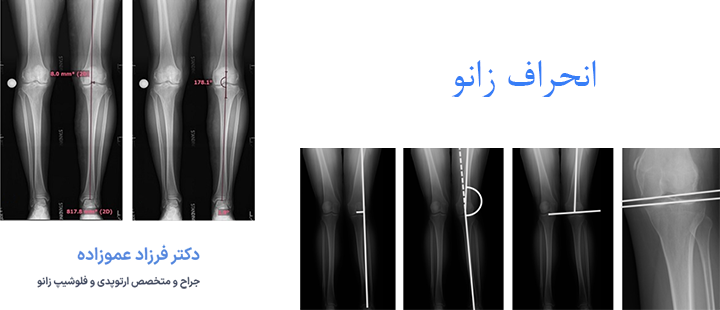 انحراف زانو چیست؟