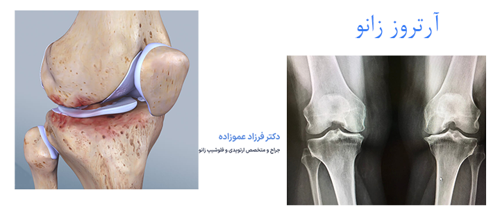 درباره آرتروز زانو