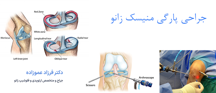 درباره جراحی پارگی منیسک زانو