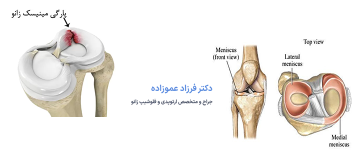 درباره پارگی منیسک زانو