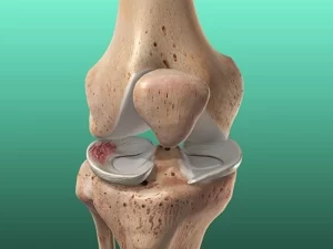 پارگی منیسک زانو