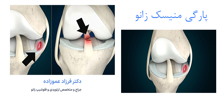پارگی منیسک زانو چیست؟