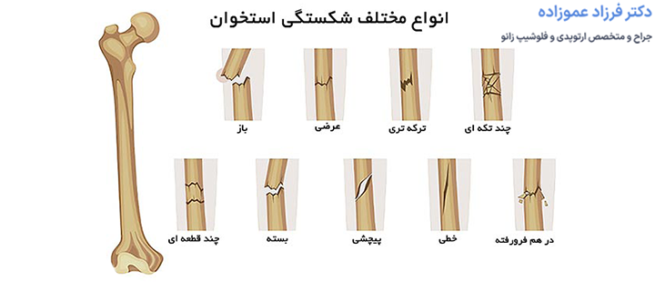 آشنایی با انواع شکستگی استخوان