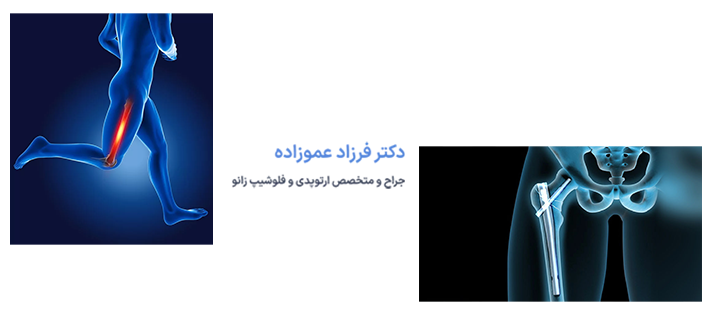 آشنایی با شکستگی استخوان ران