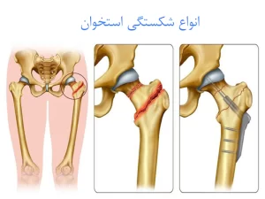 انواع شکستگی استخوان