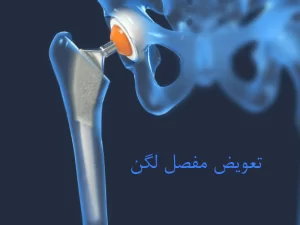 تعویض مفصل لگن