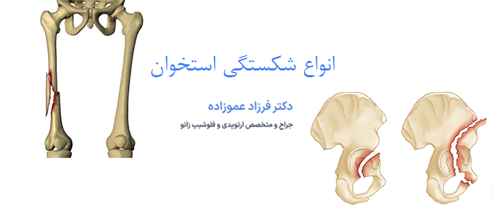 درباره انواع شکستگی استخوان