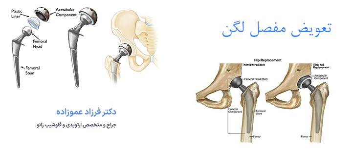 درباره تعویض مفصل لگن