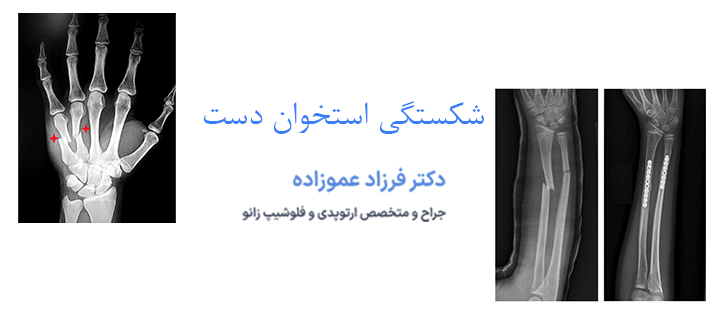 درباره شکستگی استخوان دست