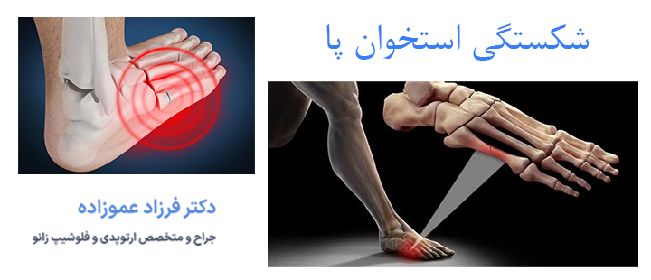آشنایی با شکستگی استخوان پا