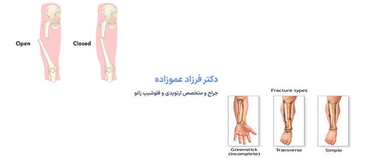 شکستگی استخوان چه انواعی دارد؟