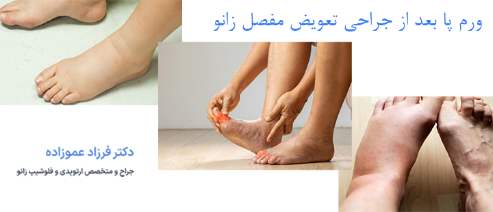درباره ورم پا بعد از جراحی تعویض مفصل زانو