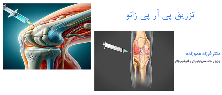 درباره تزریق پی آر پی زانو