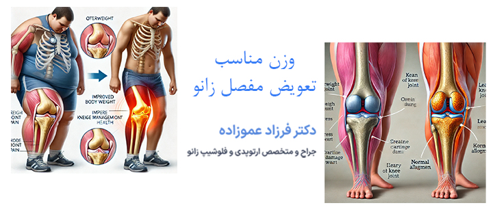 درباره وزن مناسب تعویض مفصل زانو