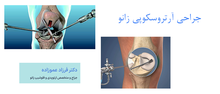 درباره جراحی آرتروسکوپی زانو