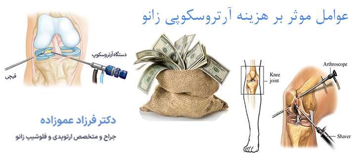 هزینه آرتروسکوپی زانو