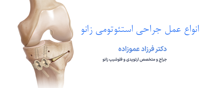انواع جراحی استئوتومی زانو