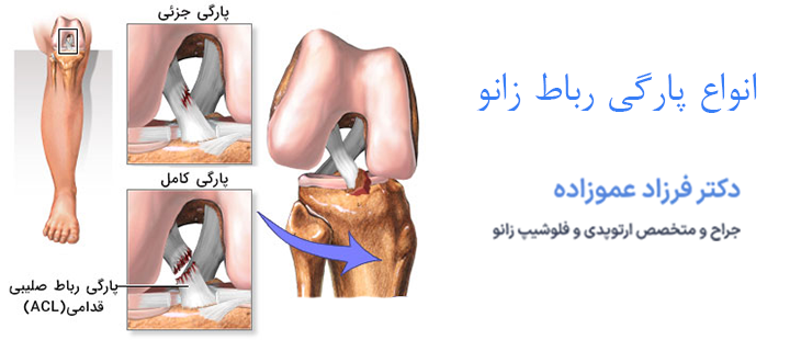 انواع پارگی رباط زانو
