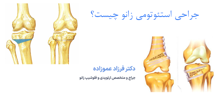 جراحی استئوتومی زانو و علت انجام آن