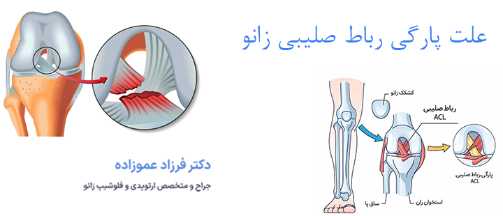 علت پارگی رباط صلیبی زانو