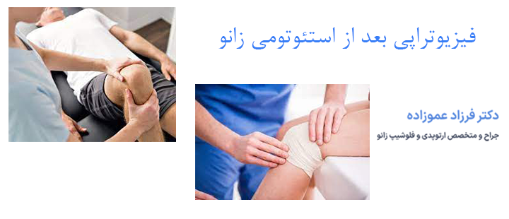 فیزیوتراپی بعد از استئوتومی زانو