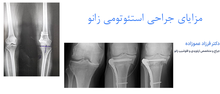 مزایای جراحی استئوتومی زانو