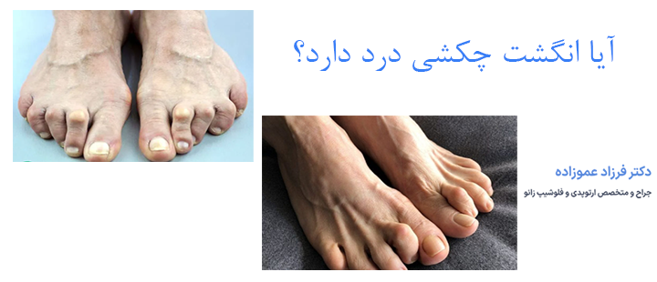 آیا انگشت چکشی دردناک است؟