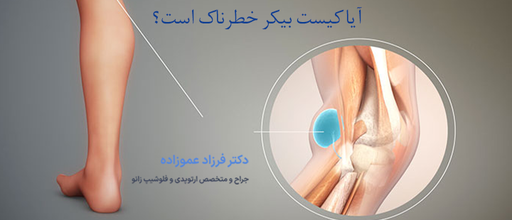 آیا کیست بیکر خطرناک است؟