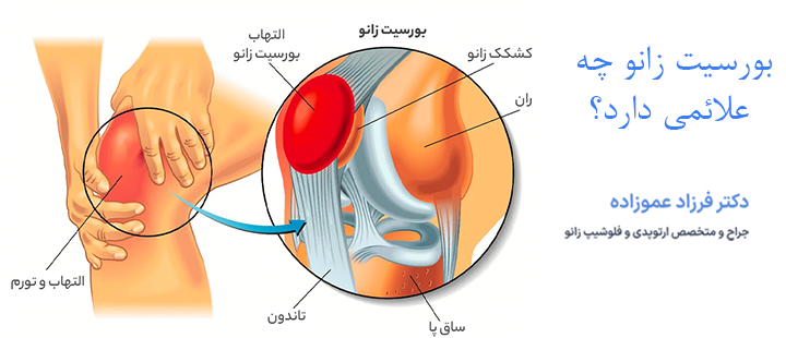 بورسیت زانو چه علائمی دارد؟