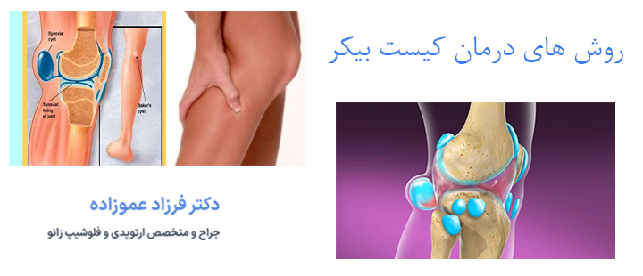 روش های درمان کیست بیکر