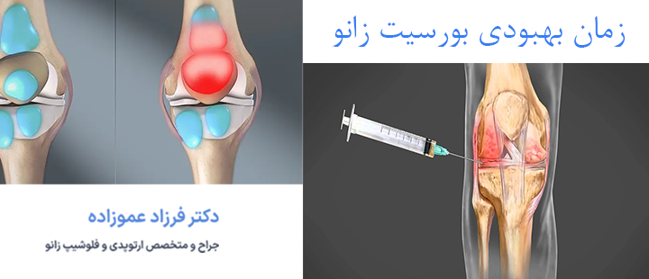 زمان بهبودی بورسیت زانو