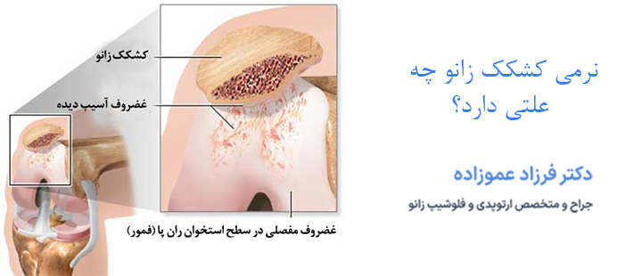 درمان نرمی کشکک زانو