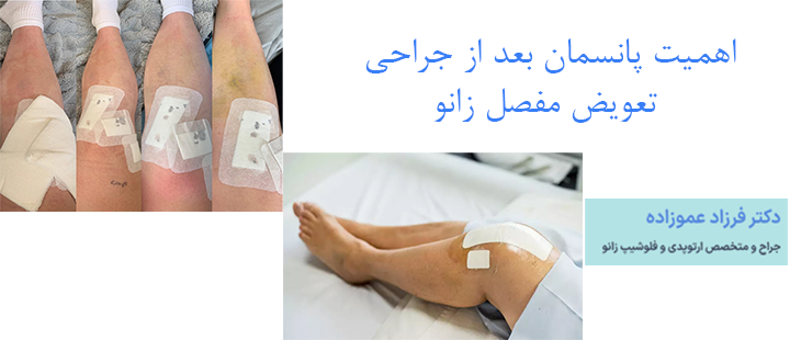 اهمیت پانسمان بعد از جراحی تعویض مفصل زانو