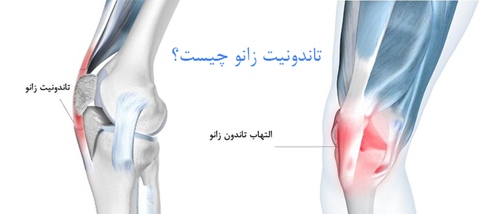 تاندونیت زانو چیست؟