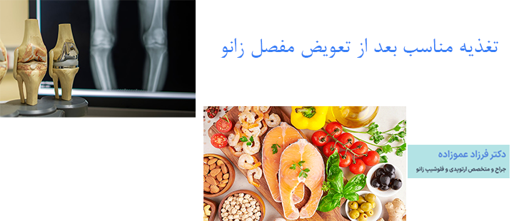 تغذیه مناسب بعد از تعویض مفصل زانو