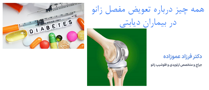 همه چیز درباره تعویض مفصل زانو در بیماران دیابتی