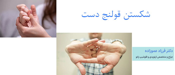 شکستن قولنج دست
