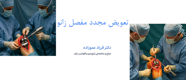 درباره تعویض مجدد مفصل زانو